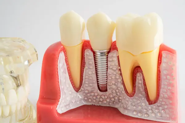 Diş implantı, çeneye yapay diş kökleri, diş tedavisinin kök kanalı, diş eti hastalığı, diş hekimliği üzerine çalışan dişçi modeli.