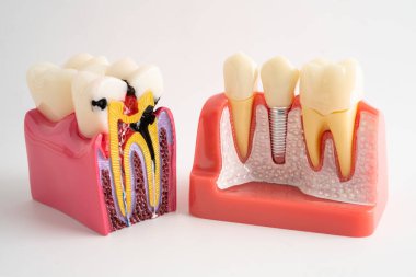 Diş implantı, çeneye yapay diş kökleri, diş tedavisinin kök kanalı, diş eti hastalığı, diş hekimliği üzerine çalışan dişçi modeli.