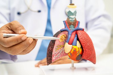 Zatürree, akciğer kanseri, Asyalı doktor hastanede teşhis ve tedavi için insan anatomisi modeli tutuyor.