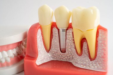 Diş implantı, çeneye yapay diş kökleri, diş tedavisinin kök kanalı, diş eti hastalığı, diş hekimliği üzerine çalışan dişçi modeli.