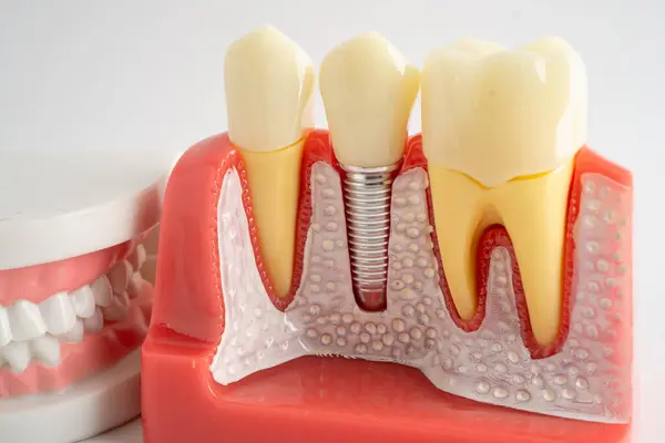 Diş implantı, çeneye yapay diş kökleri, diş tedavisinin kök kanalı, diş eti hastalığı, diş hekimliği üzerine çalışan dişçi modeli.