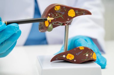 Dünya Hepatit Günü 'nde siroz, karaciğer kanseri, yağlı karaciğer, karaciğer anatomisi olan Asyalı doktor..