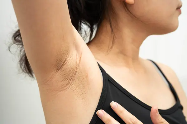 Asyalı kadınların siyah koltuk altı güzellik sorunları vardır..