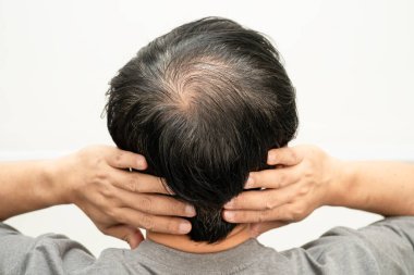 Kel kafalı adam, saç dökülmesi tedavisi sorunu.