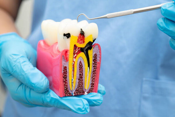 Teeth root dental model with tool for dentist use to cleaning care treatment.