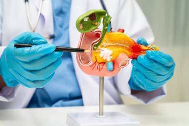 Pankreas iltihabı, pankreas hastası Asyalı doktor, safra kesesi ve safra kesesi insan anatomisi modeli..