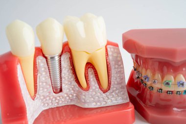 Diş implantı, çeneye yapay diş kökleri, diş tedavisinin kök kanalı, diş eti hastalığı, diş hekimliği üzerine çalışan dişçi modeli.