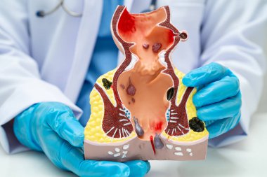 Hastanede rektum ve hemoroit insan anatomisi modeli olan Asyalı bir doktor vasküler yapısında iltihaplanma var..
