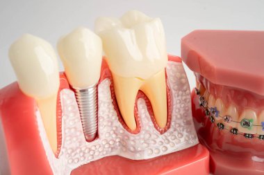 Diş implantı, çeneye yapay diş kökleri, diş tedavisinin kök kanalı, diş eti hastalığı, diş hekimliği üzerine çalışan dişçi modeli.