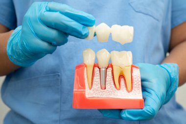 Diş implantı, çeneye yapay diş kökleri, diş tedavisinin kök kanalı, diş eti hastalığı, diş hekimliği üzerine çalışan dişçi modeli.