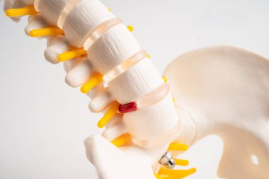 Omurga ve kemik, bel kemiği yerinden oynamış disk parçası, ortopedi bölümünde tedavi için model..