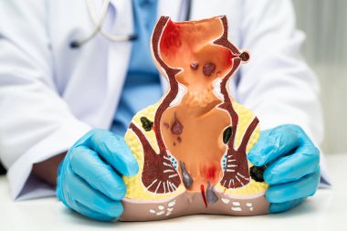 Hastanede rektum ve hemoroit insan anatomisi modeli olan Asyalı bir doktor vasküler yapısında iltihaplanma var..