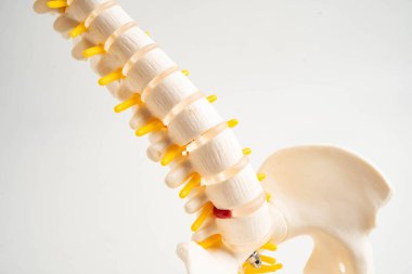 Omurga ve kemik, bel kemiği yerinden oynamış disk parçası, ortopedi bölümünde tedavi için model..