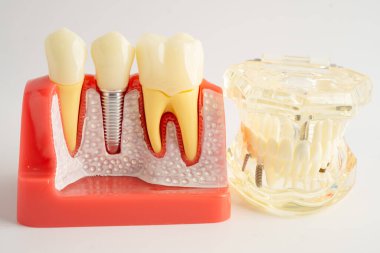 Diş implantı, çeneye yapay diş kökleri, diş tedavisinin kök kanalı, diş eti hastalığı, diş hekimliği üzerine çalışan dişçi modeli.