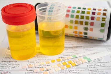 İdrar tahlili, reaksiyonlu idrar kabı. PH kağıt testi ve karşılaştırma tablosu laboratuvarda..