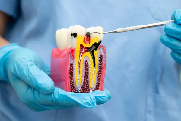 Diş sağlığı tedavisinde kullanılan diş köküne sahip diş modeli.