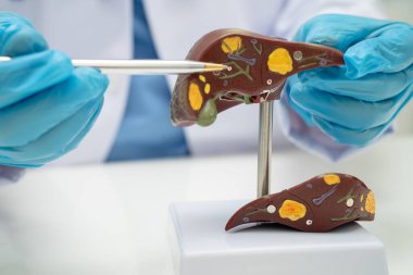 Dünya Hepatit Günü 'nde siroz, karaciğer kanseri, yağlı karaciğer, karaciğer anatomisi olan Asyalı doktor..