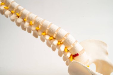 Omurga ve kemik, bel kemiği yerinden oynamış disk parçası, ortopedi bölümünde tedavi için model..