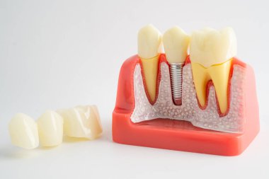 Diş implantı, çeneye yapay diş kökleri, diş tedavisinin kök kanalı, diş eti hastalığı, diş hekimliği üzerine çalışan dişçi modeli.