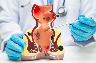 Hastanede rektum ve hemoroit insan anatomisi modeli olan Asyalı bir doktor vasküler yapısında iltihaplanma var..