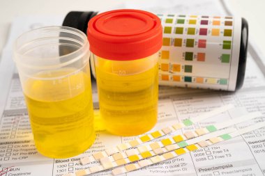 İdrar tahlili, reaksiyonlu idrar kabı. PH kağıt testi ve karşılaştırma tablosu laboratuvarda..