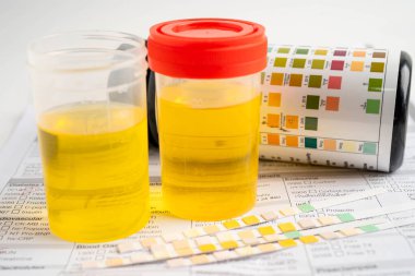 İdrar tahlili, reaksiyonlu idrar kabı. PH kağıt testi ve karşılaştırma tablosu laboratuvarda..
