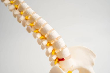 Omurga ve kemik, bel kemiği yerinden oynamış disk parçası, ortopedi bölümünde tedavi için model..