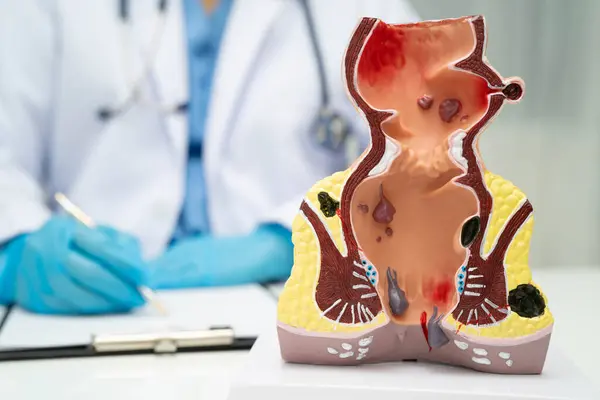 Hastanede rektum ve hemoroit insan anatomisi modeli olan Asyalı bir doktor vasküler yapısında iltihaplanma var..