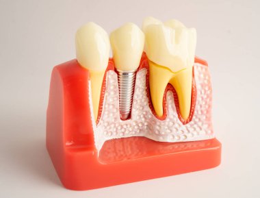 Diş implantı, yapay diş kökleri çene içine izole beyaz arkaplan kırpma yolu ile.