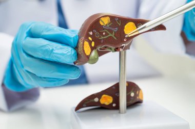 Dünya Hepatit Günü 'nde siroz, karaciğer kanseri, yağlı karaciğer, karaciğer anatomisi olan Asyalı doktor..