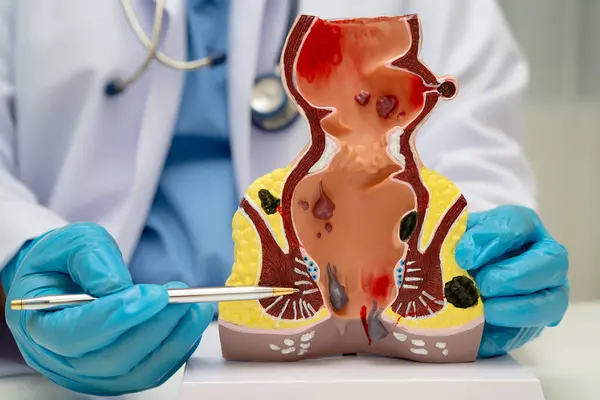 Hastanede rektum ve hemoroit insan anatomisi modeli olan Asyalı bir doktor vasküler yapısında iltihaplanma var..