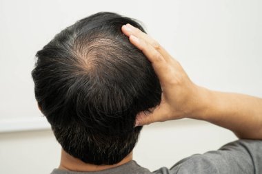 Kel kafalı adam, saç dökülmesi tedavisi sorunu.