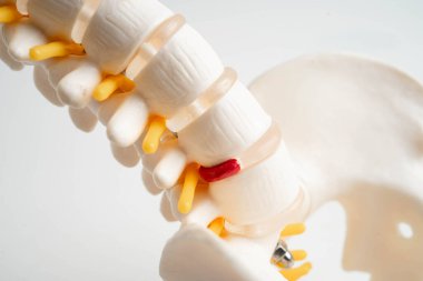 Omurga ve kemik, bel kemiği yerinden oynamış disk parçası, ortopedi bölümünde tedavi için model..