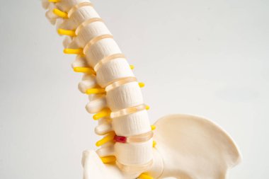 Omurga ve kemik, bel kemiği yerinden oynamış disk parçası, ortopedi bölümünde tedavi için model..