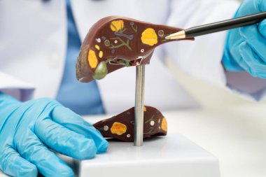 Dünya Hepatit Günü 'nde siroz, karaciğer kanseri, yağlı karaciğer, karaciğer anatomisi olan Asyalı doktor..