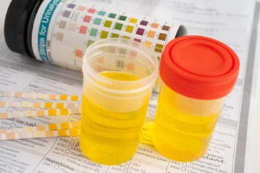 İdrar tahlili, reaksiyonlu idrar kabı. PH kağıt testi ve karşılaştırma tablosu laboratuvarda..