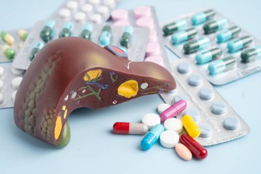 Hap tedavisi gören karaciğer modeli, siroz, karaciğer kanseri, yağlı karaciğer..