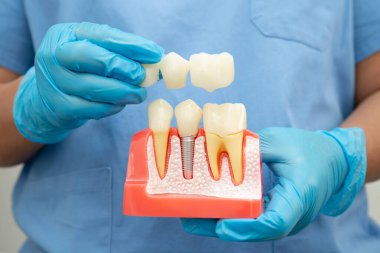 Diş implantı, çeneye yapay diş kökleri, diş tedavisinin kök kanalı, diş eti hastalığı, diş hekimliği üzerine çalışan dişçi modeli.