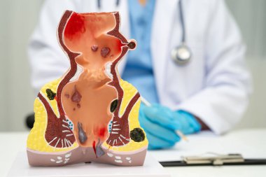 Hastanede rektum ve hemoroit insan anatomisi modeli olan Asyalı bir doktor vasküler yapısında iltihaplanma var..