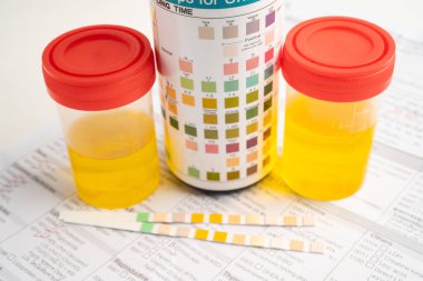 İdrar tahlili, reaksiyonlu idrar kabı. PH kağıt testi ve karşılaştırma tablosu laboratuvarda..