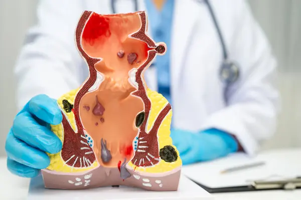 Hastanede rektum ve hemoroit insan anatomisi modeli olan Asyalı bir doktor vasküler yapısında iltihaplanma var..