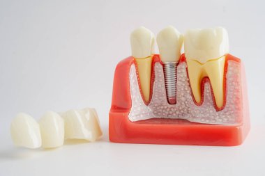 Diş implantı, çeneye yapay diş kökleri, diş tedavisinin kök kanalı, diş eti hastalığı, diş hekimliği üzerine çalışan dişçi modeli.