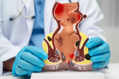 Hastanede rektum ve hemoroit insan anatomisi modeli olan Asyalı bir doktor vasküler yapısında iltihaplanma var..