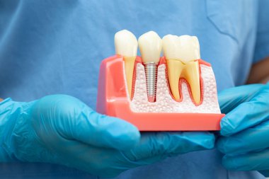 Diş sağlığı tedavisinde kullanılan diş köküne sahip diş modeli.