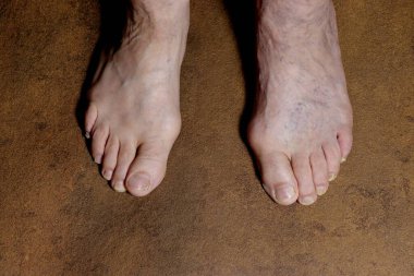 Ayak başparmağı kıvrımlı bir yetişkinin bacakları..