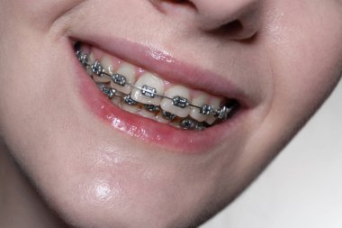 Mutluluk ve diş telleri: Metal tellerle odaklanmış canlı bir kızın gülümsemesi, ortodontik tedavi sırasında olumlu bir tavrı somutlaştırıyor. Temiz dişler ve kablolar hijyen ve diş bakımının önemini yansıtır.