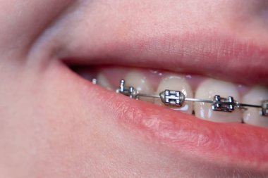 Devam eden bir gülümseme: Hafifçe açık bir ağız diş telleriyle dişleri ortaya çıkarır, mükemmelliğe giden yolculuğu sembolize eder. Diş telleri yavaş yavaş düzgün ve uyumlu bir diş kemerine ulaşmamıza yardımcı olur..