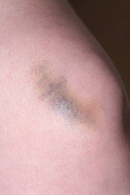 Cildindeki morluğun yakın çekimi yaranın ciddiyetini gösteriyor. Çürüğün mavi-sarı tonu travmanın şiddetini ve iyileşme aşamalarını gösteriyor..