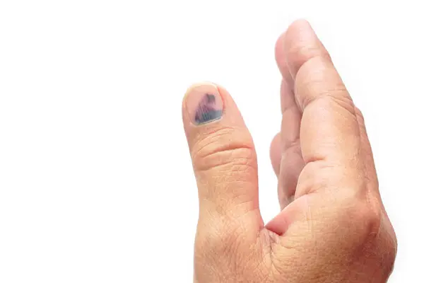 Çürük tırnaklı başparmak, beyaz arka planda subbungual hematom. Acı verici çürükler, kaza, yaralı parmaklar ve tıbbi konsept.