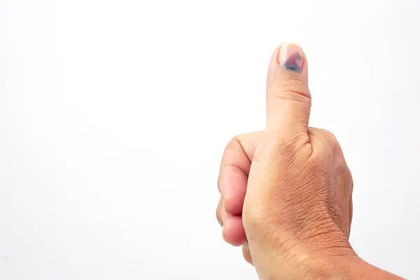 Çürük tırnaklı başparmak, beyaz arka planda subbungual hematom. Acı verici çürükler, kaza, yaralı parmaklar ve tıbbi konsept.
